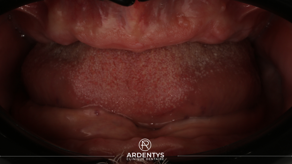 Réhabilitation complète bi maxillaire