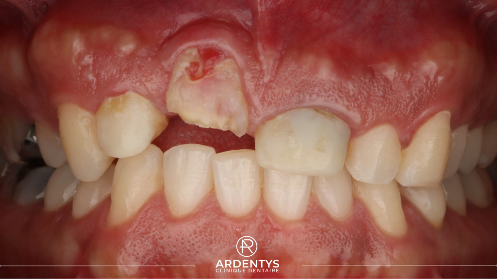 Réhabilitation partielle