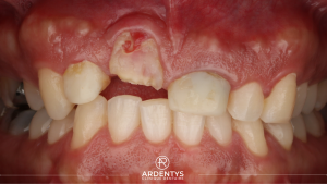 Réhabilitation partielle