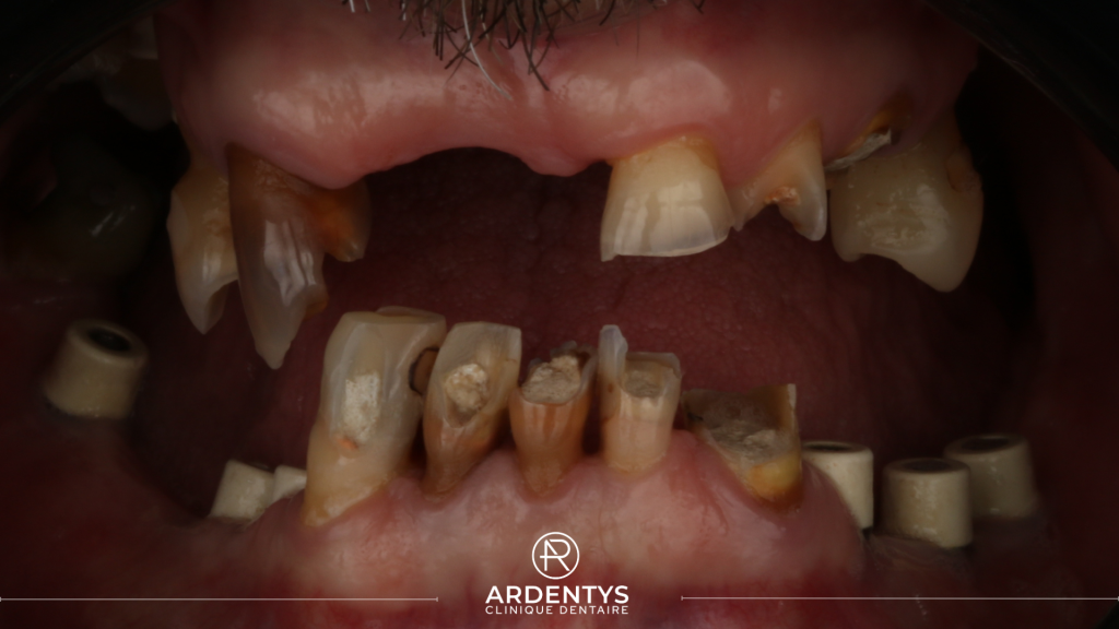 Réhabilitation complète bi maxillaire