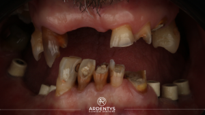 Réhabilitation complète bi maxillaire