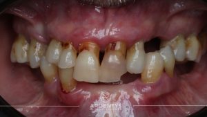 Réhabilitation complète bi maxillaire