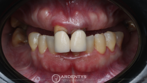 Réhabilitation complète uni maxillaire