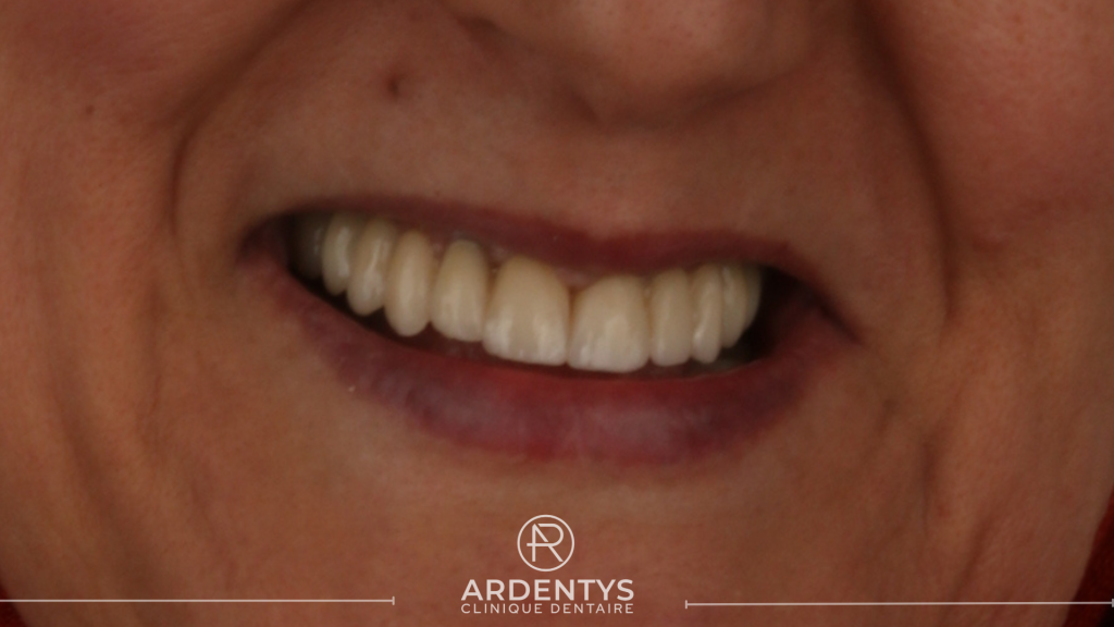 Réhabilitation complète bi maxillaire