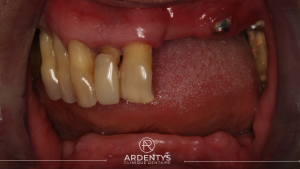 Réhabilitation complète bi maxillaire