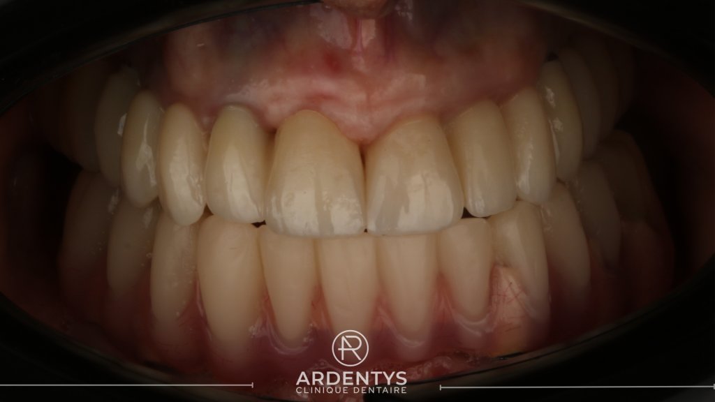 Réhabilitation complète bi maxillaire