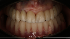 Réhabilitation complète bi maxillaire