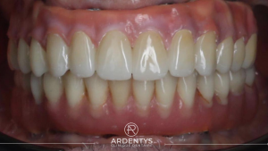 Réhabilitation complète bi maxillaire