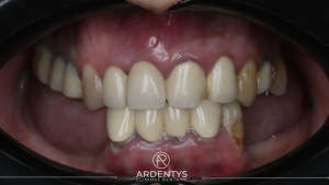 Réhabilitation complète bi maxillaire