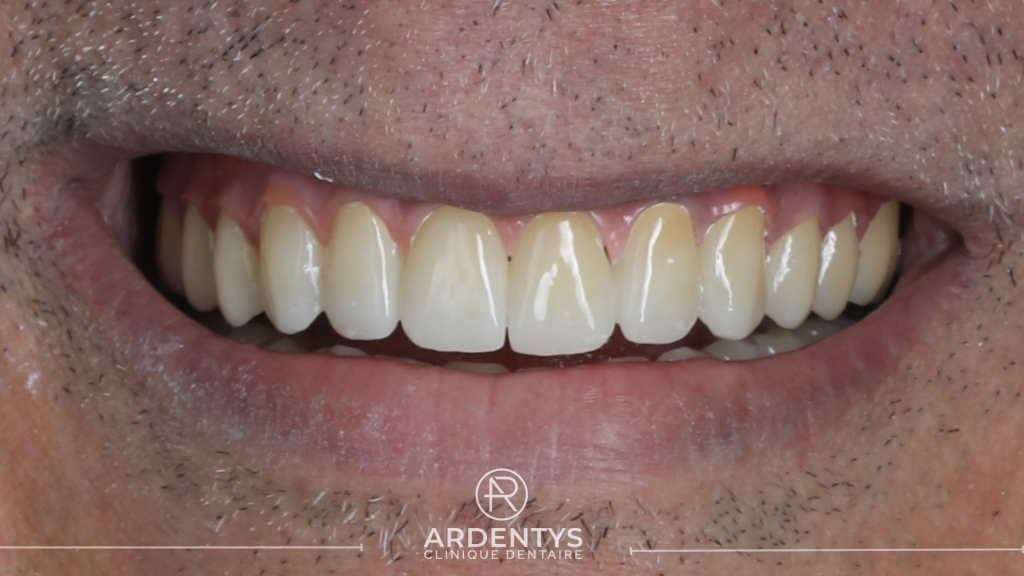 Réhabilitation complète bi maxillaire