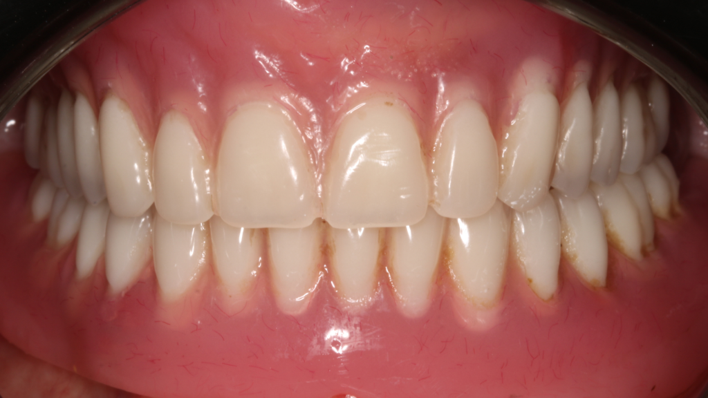 Réhabilitation complète bi maxillaire