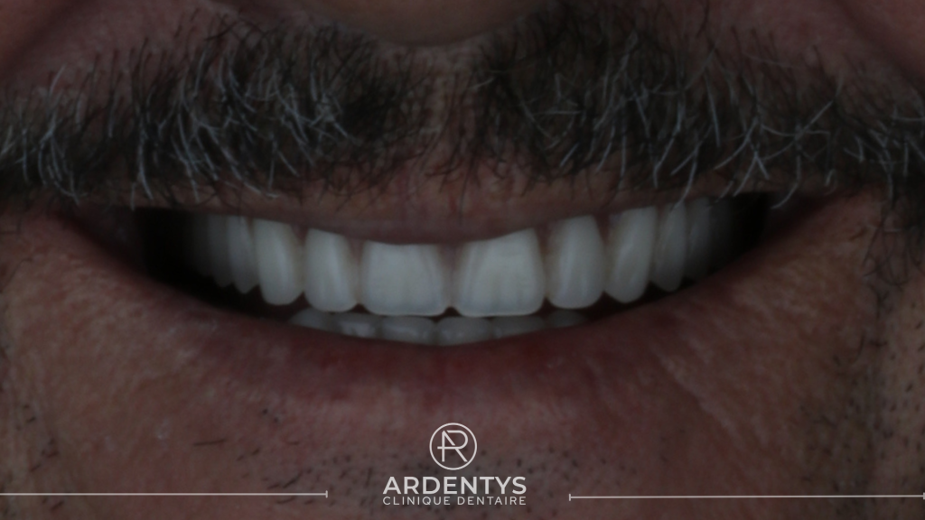 Réhabilitation complète bi maxillaire