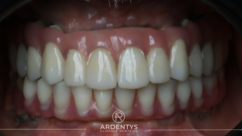 Réhabilitation complète bi maxillaire