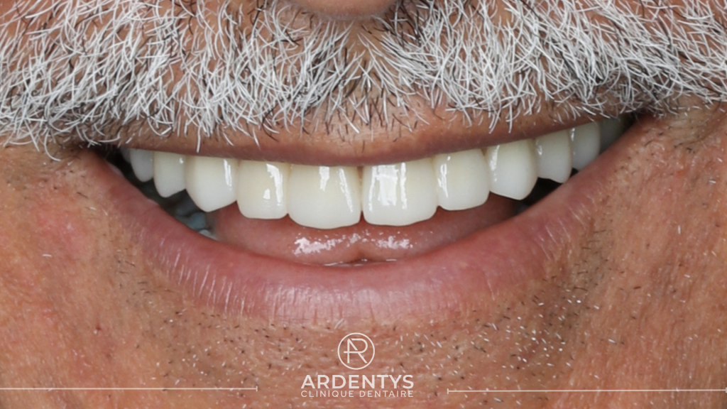 Réhabilitation complète bi maxillaire