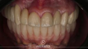 Réhabilitation complète uni maxillaire