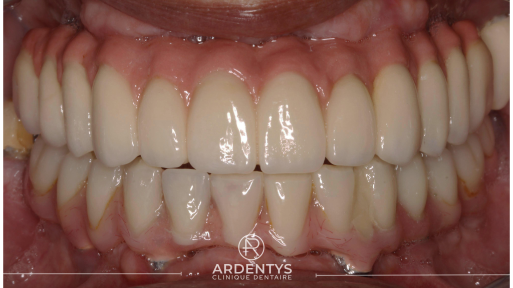 Réhabilitation complète bi maxillaire