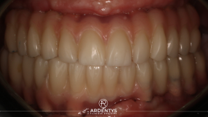 Réhabilitation complète bi maxillaire