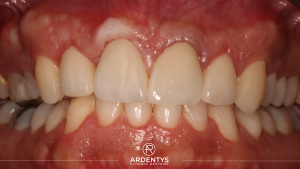 Réhabilitation partielle