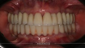 Réhabilitation complète bi maxillaire