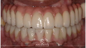 Réhabilitation complète bi maxillaire