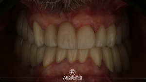 Réhabilitation complète bi maxillaire