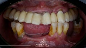 Réhabilitation complète bi maxillaire