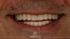 Réhabilitation complète bi maxillaire