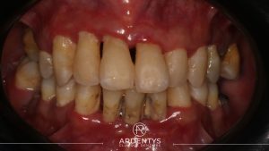 Réhabilitation complète uni maxillaire