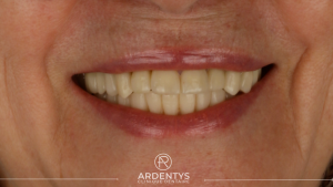 Réhabilitation complète uni maxillaire