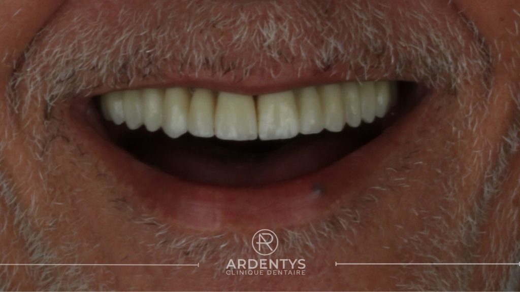 Réhabilitation complète bi maxillaire