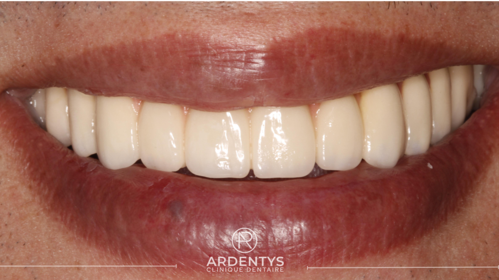 Réhabilitation complète bi maxillaire