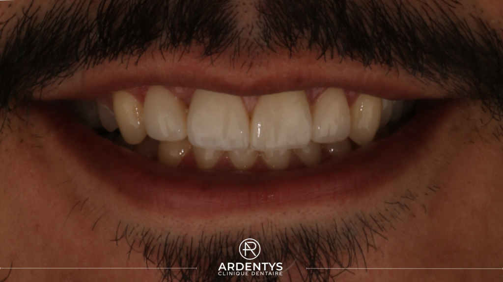 Réhabilitation partielle