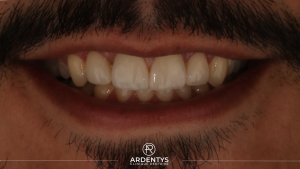 Réhabilitation partielle