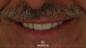 Réhabilitation complète bi maxillaire