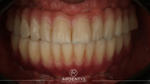 Réhabilitation complète uni maxillaire