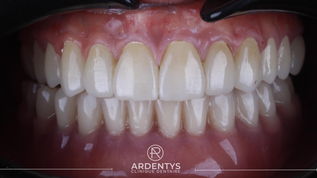 Réhabilitation complète bi maxillaire