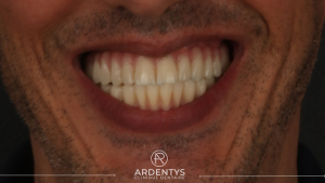 Réhabilitation complète uni maxillaire