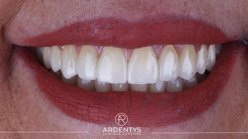 Réhabilitation complète bi maxillaire