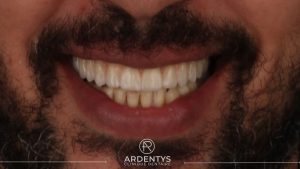 Réhabilitation complète uni maxillaire