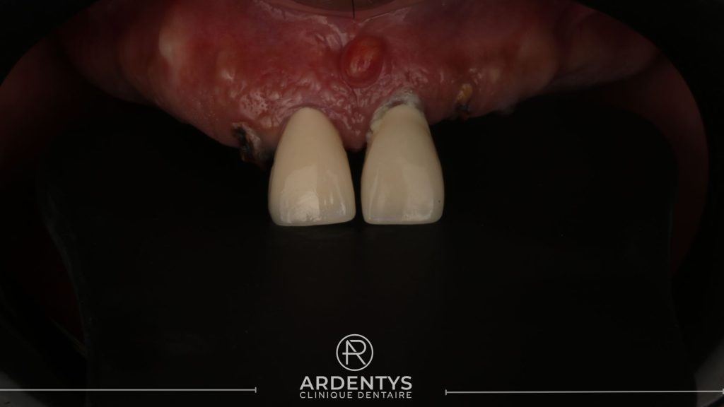 Réhabilitation complète uni maxillaire