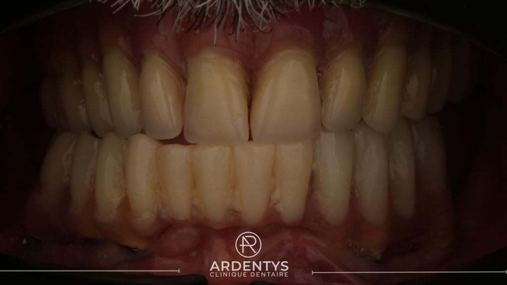 Réhabilitation complète bi maxillaire