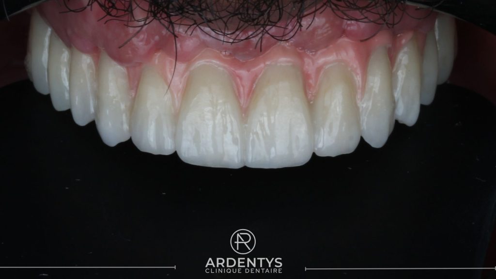 Réhabilitation complète uni maxillaire