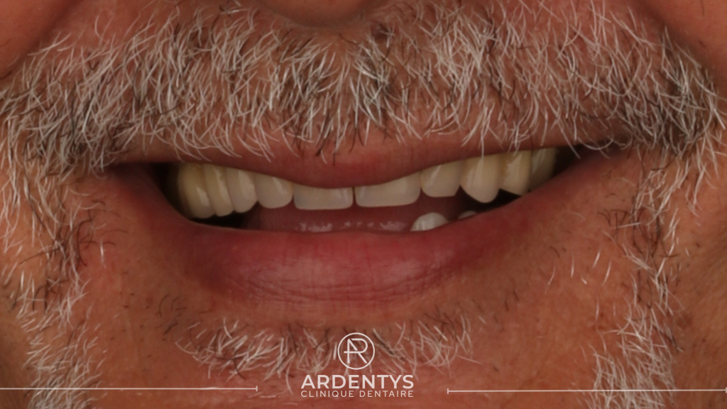 Réhabilitation complète bi maxillaire