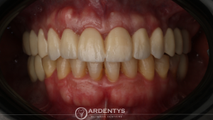 Réhabilitation complète uni maxillaire