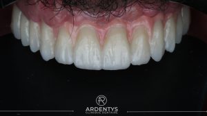 Réhabilitation complète uni maxillaire