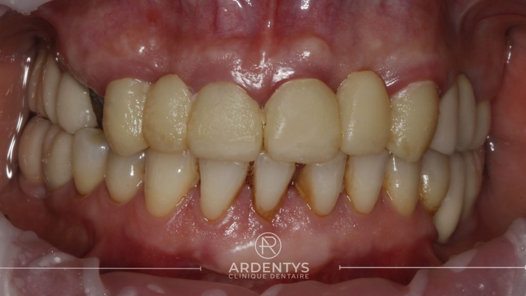 Réhabilitation complète uni maxillaire