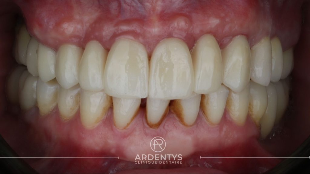 Réhabilitation complète uni maxillaire