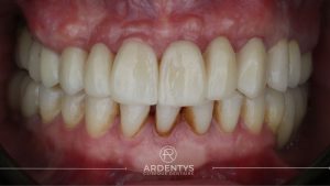 Réhabilitation partielle