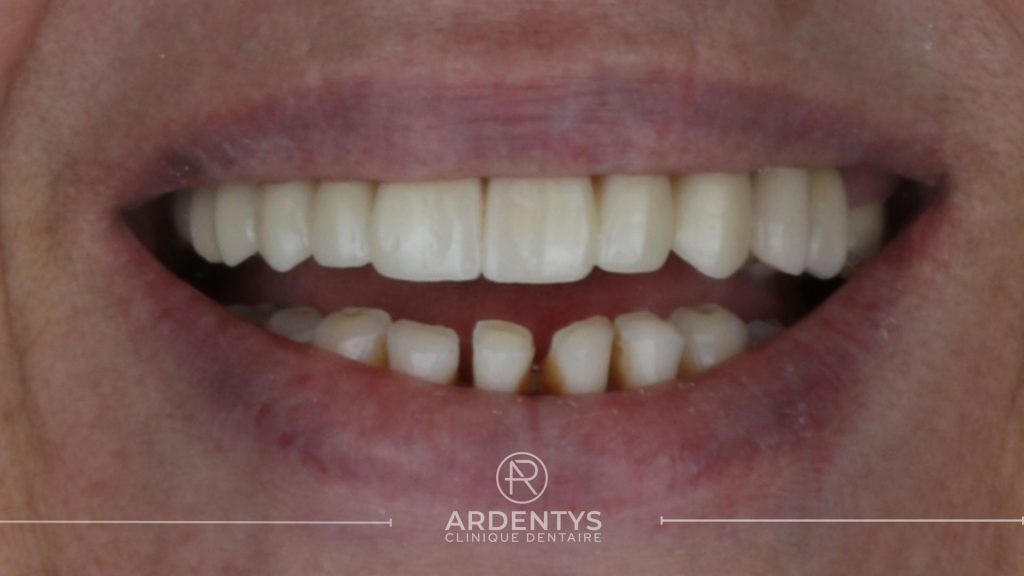 Réhabilitation complète uni maxillaire