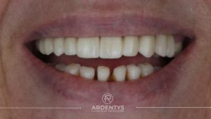 Réhabilitation partielle